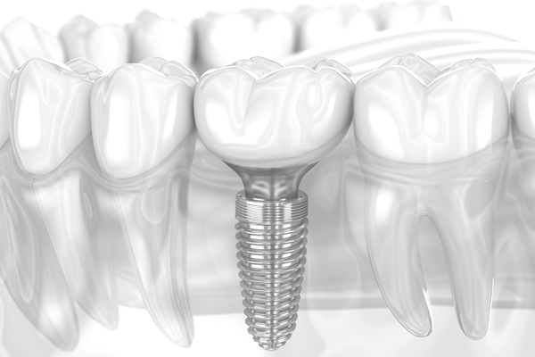 Why You Should Not Fear The Surgery To Get Tooth Implants