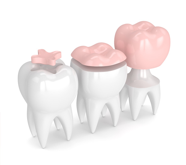 Key West Dental Inlays and Onlays
