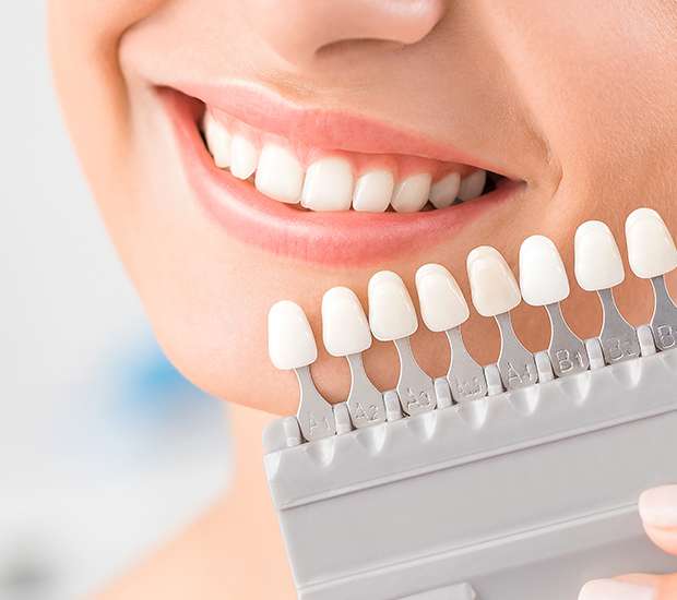 Key West Dental Veneers and Dental Laminates