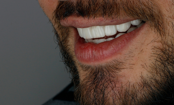 What You Need To Know About At Home Teeth Whitening From A Dentist